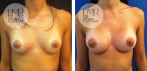 LMR Cirurgia Plástica - Mamoplastia de Aumento