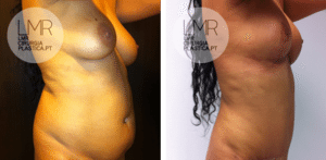 Abdominoplastia antes e depois