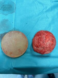 contratura capsular