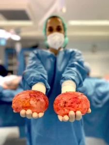 contratura capsular é um dos riscos das cirurgias de aumento mamário