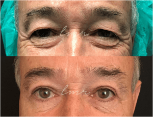 Blefaroplastia - Resultados da Cirurgia para remover papos nos olhos 