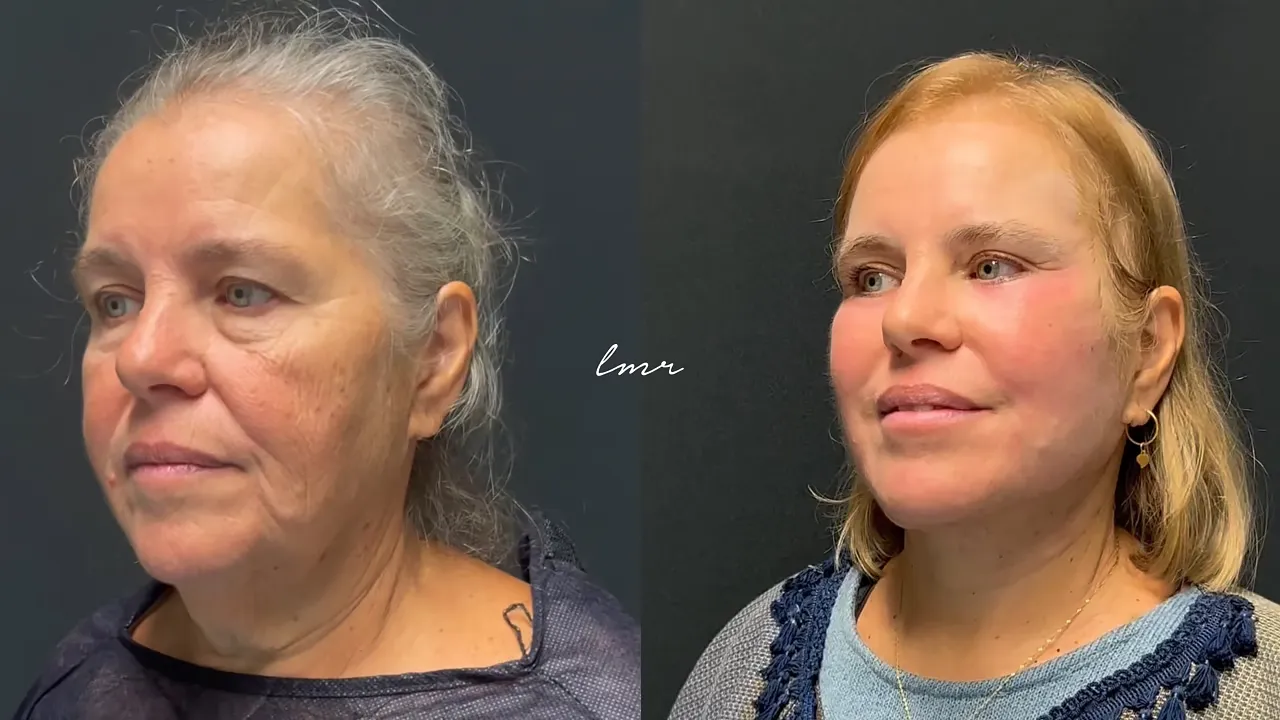Facelift / Neck Lift